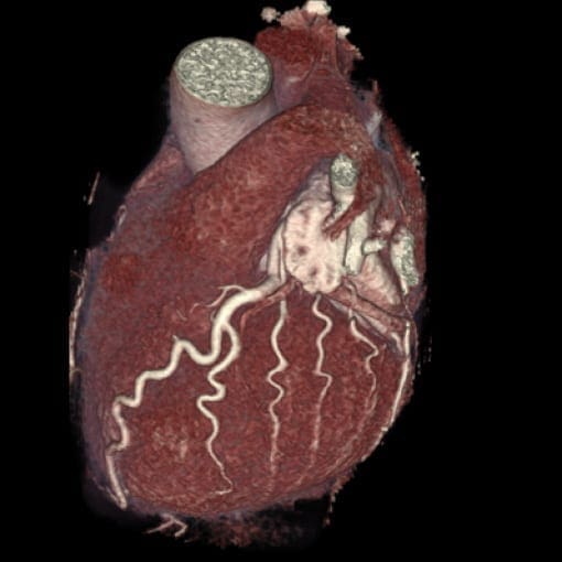CT-Angiographie Herz (Cardio-CT)