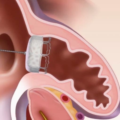 Occluder-Therapie: Verschlusssysteme für Löcher und Vorhofohr