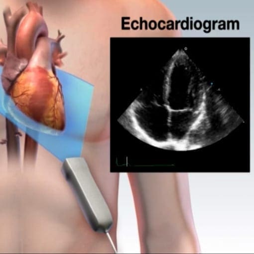 Echokardiographie (Video) UKG
