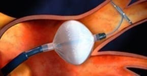 BlurbKryoablation