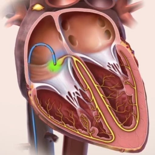 Ablation von Herzrhythmusstörungen