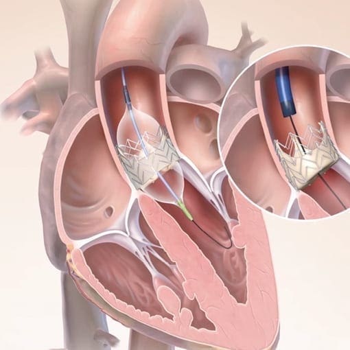 TAVI: minimal invasive Klappen-OP