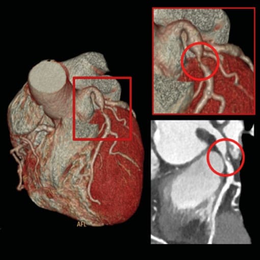 CT-Angiographie Herz