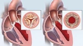 Blurb 320 TAVR5