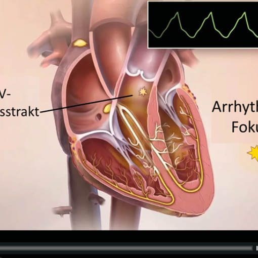 RVOT: Ausflusstrakt Tachykardie