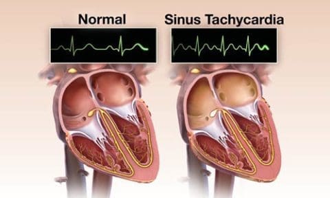 Sinustachykardie Osypka Herzzentrum München