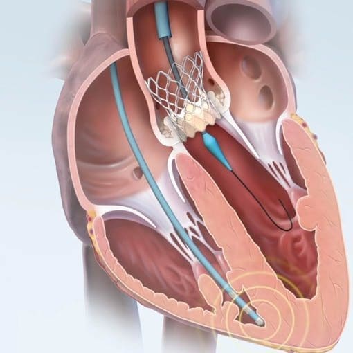 Minimal invasive Therapie Herzklappen