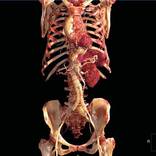 Lungen-Embolie CT