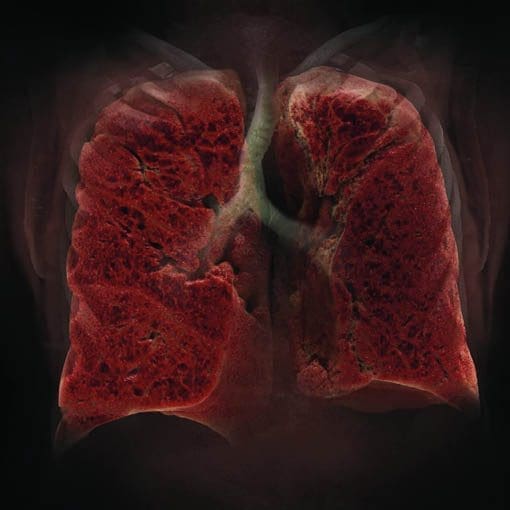 Vorsorge CT der Lunge: low-dose mit niedriger Strahlenbelastung